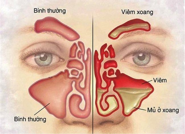 Cây lược vàng có tác dụng trị viêm xoang