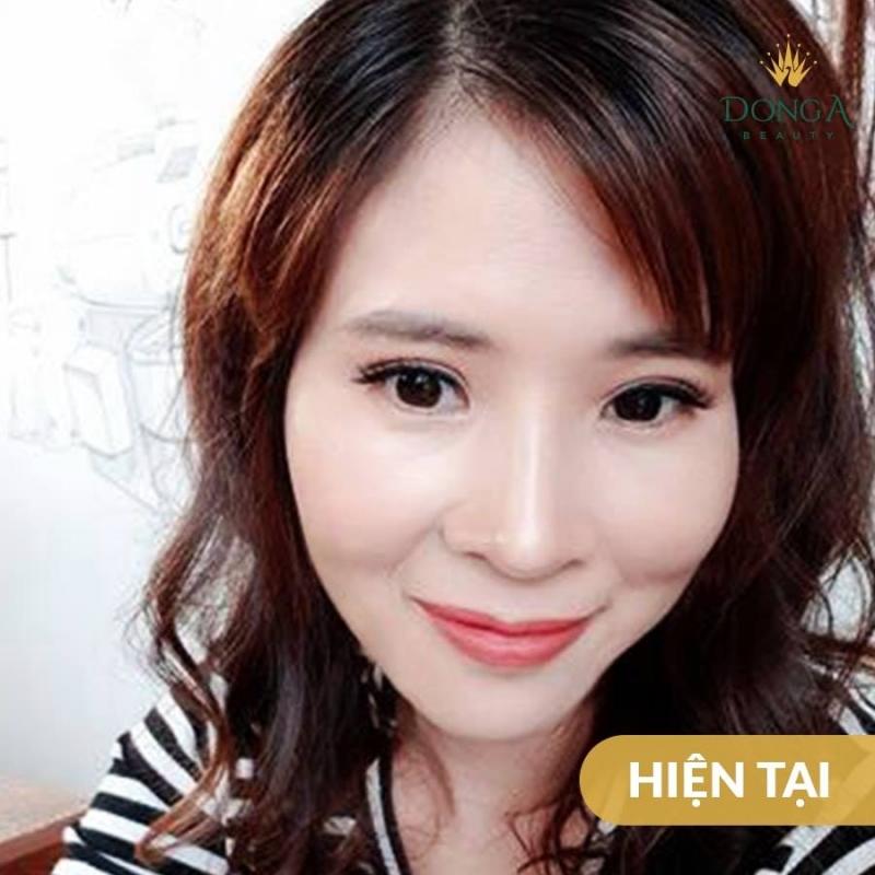 Nâng mũi S-line tại Đông Á