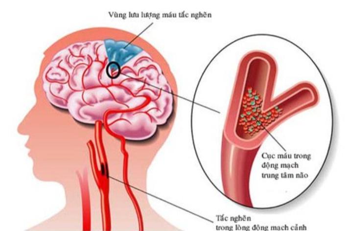 Nguyên nhân gây đột quỵ là do sự bất ổn của tuần hoàn máu não