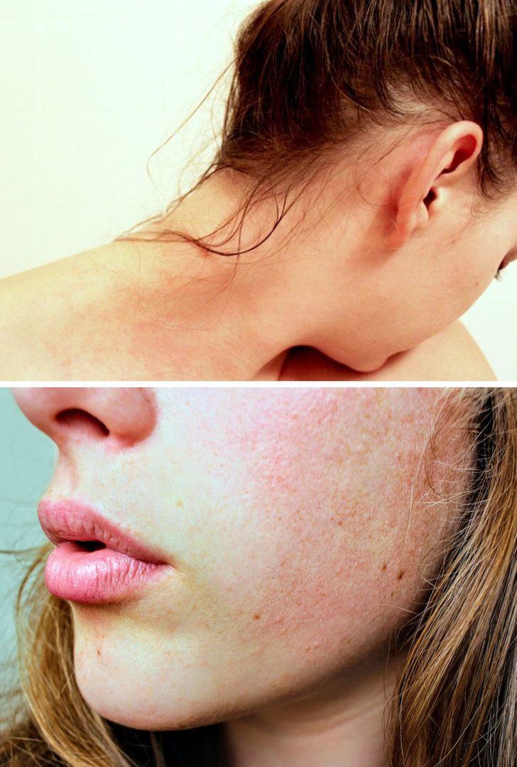 Đi ngủ khi tóc còn ẩm ướt dễ gây kích ứng da mặt