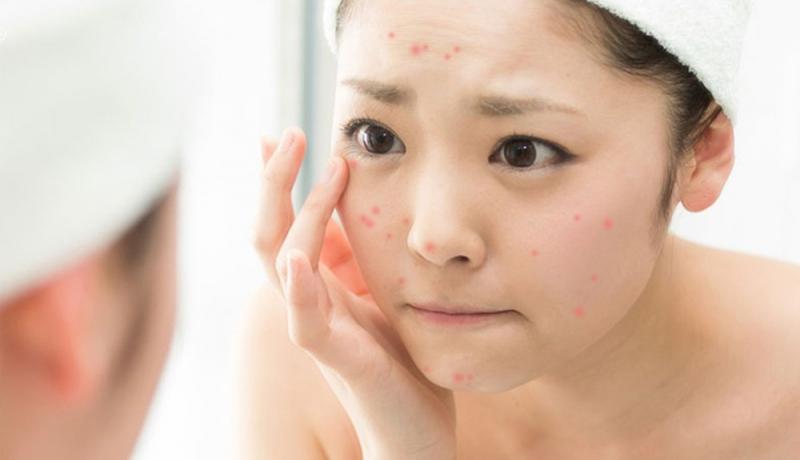 Đi ngủ khi tóc còn ẩm ướt dễ gây kích ứng da mặt