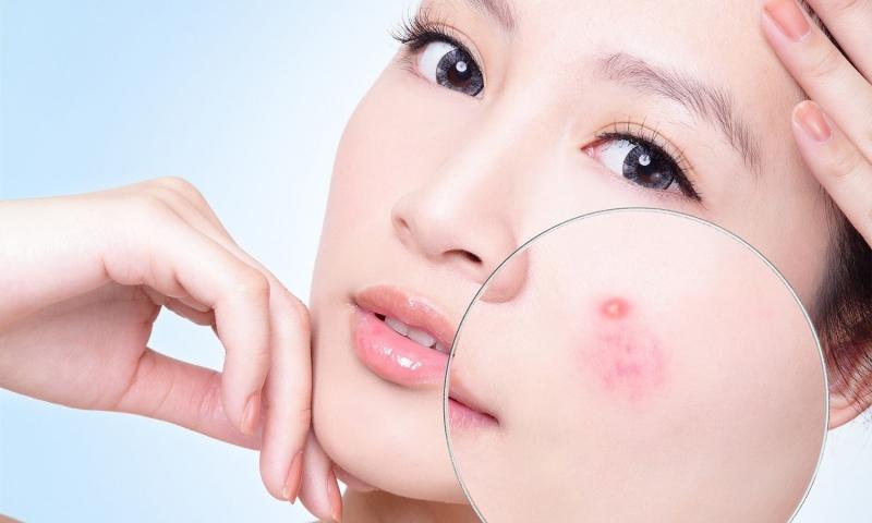 Nỗi đau khổ lớn nhất của những cô gái có làn da dầu chính là mụn.