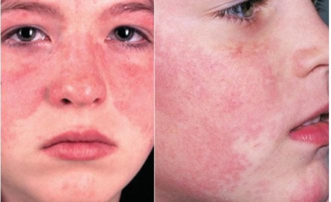 Bệnh Lupus ban đỏ hệ thống