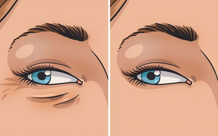 Mắt của bạn bị sưng húp