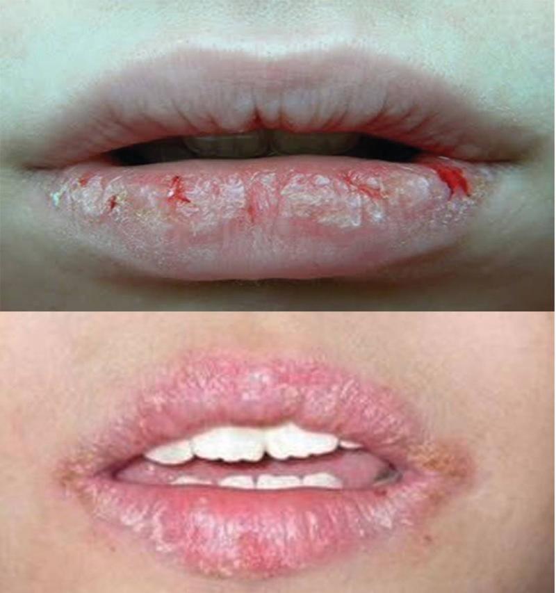 Môi khô nứt nẻ, dấu hiệu thiếu vitamin B12