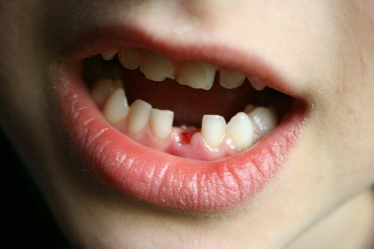 Trẻ nhỏ thường có nhiều thói quen xấu: đẩy lưỡi, mút tay, ngậm ti giả, cắn ngón tay hoặc chống cằm...