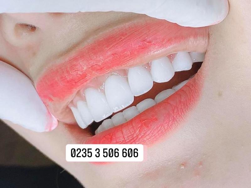 Nha Khoa Sài Gòn Duy Xuyên