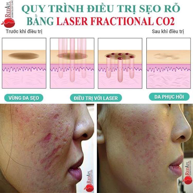 Phòng Khám Da Liễu Táo Đỏ - Chuyên trị sẹo rỗ, sẹo lõm, sẹo lồi và các loại sẹo