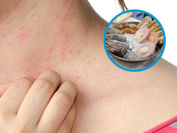 Ăn sò huyết gây dị ứng