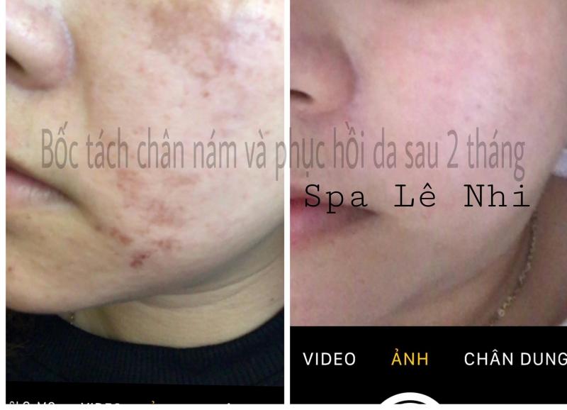 Bốc tách chân nám và phục hồi da sau 2 tháng tại Spa Lê Nhi