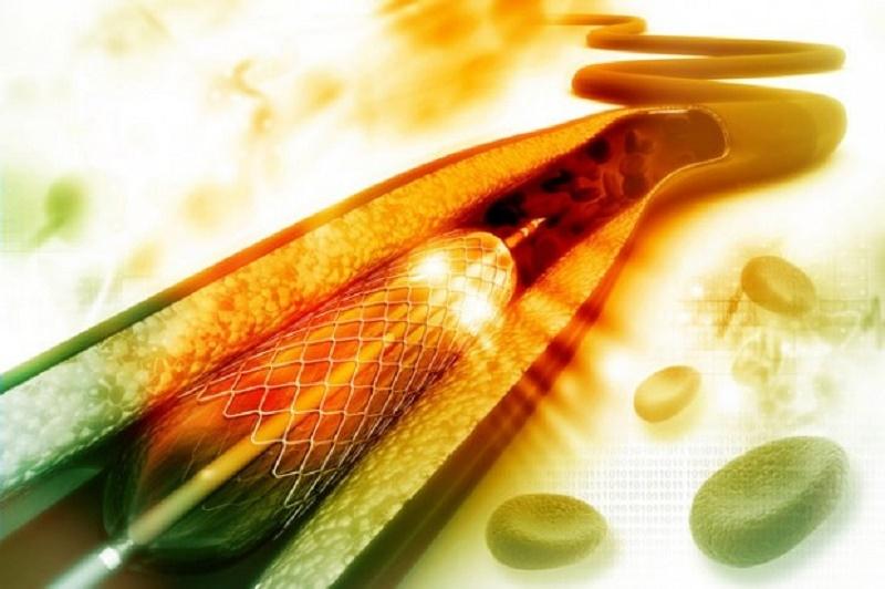 Stent tự tiêu hủy