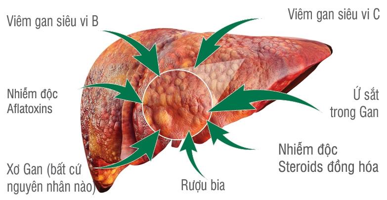 Suy gan là bệnh hiểm nghèo phổ biến nhất