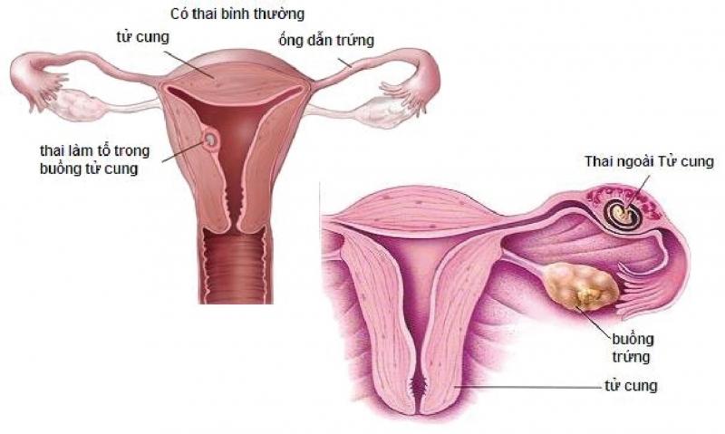 Việc tắc vòi dẫn trứng khiến trứng dù đã phối vẫn không thể thụ tinh được.