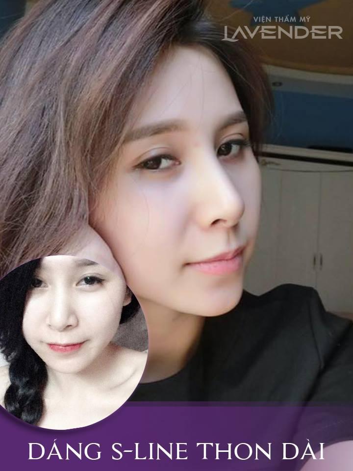 Nâng mũi S-line tại Lavender