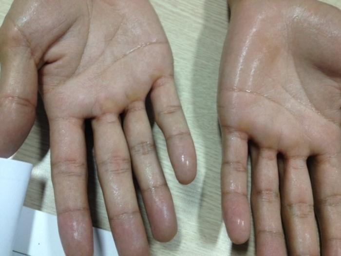 Đổ nhiều mồ hôi có thể do cường tuyến giáp