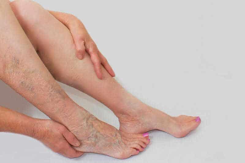Trĩ và suy tĩnh mạch mạn tính