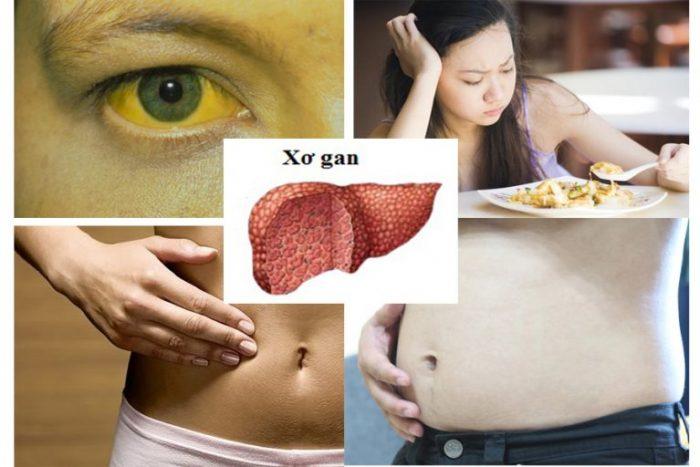 Các dấu hiệu của xơ gan