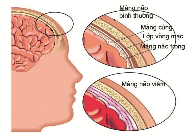 Viêm màng não mủ