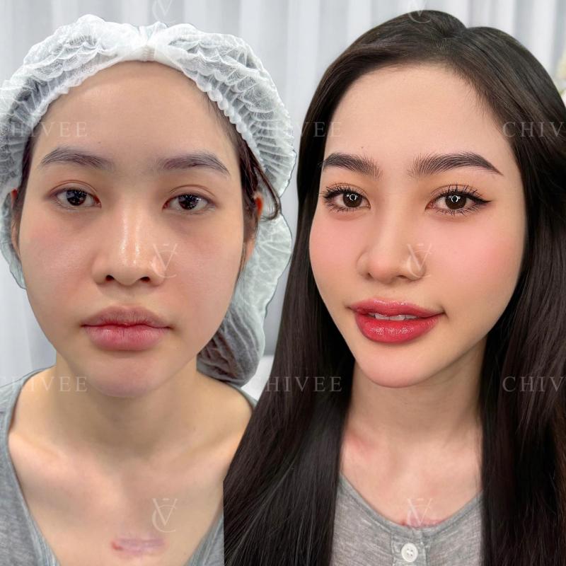 Viện Thẩm Mỹ ChiVee