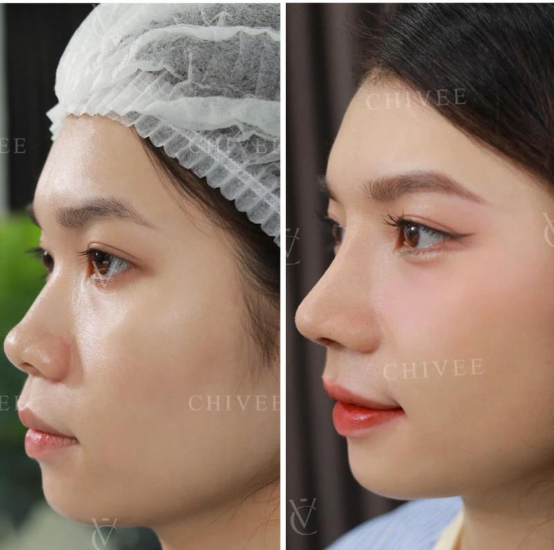 Viện Thẩm Mỹ ChiVee