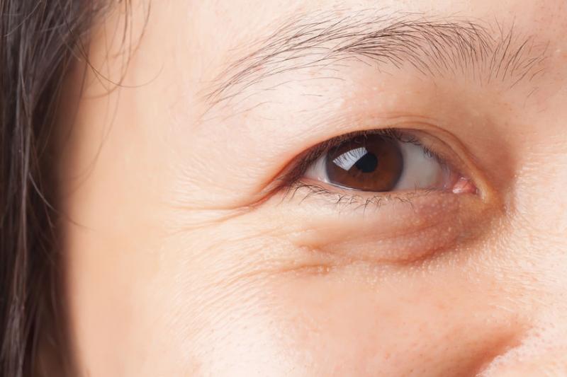 Xóa mờ vết nhăn