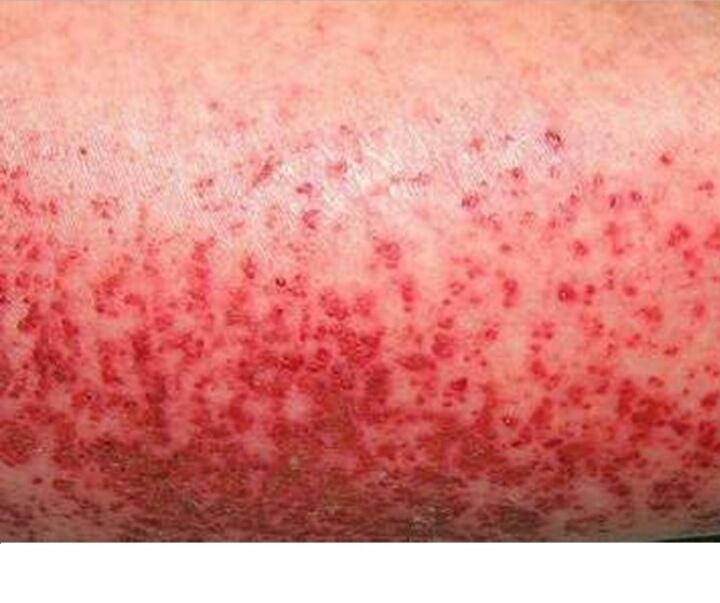Những thay đổi bất thường trên da của người mắc viêm gan B